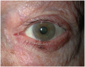 Malignant Melanoma of the eye